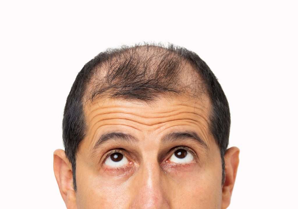 Pérdida de cabello